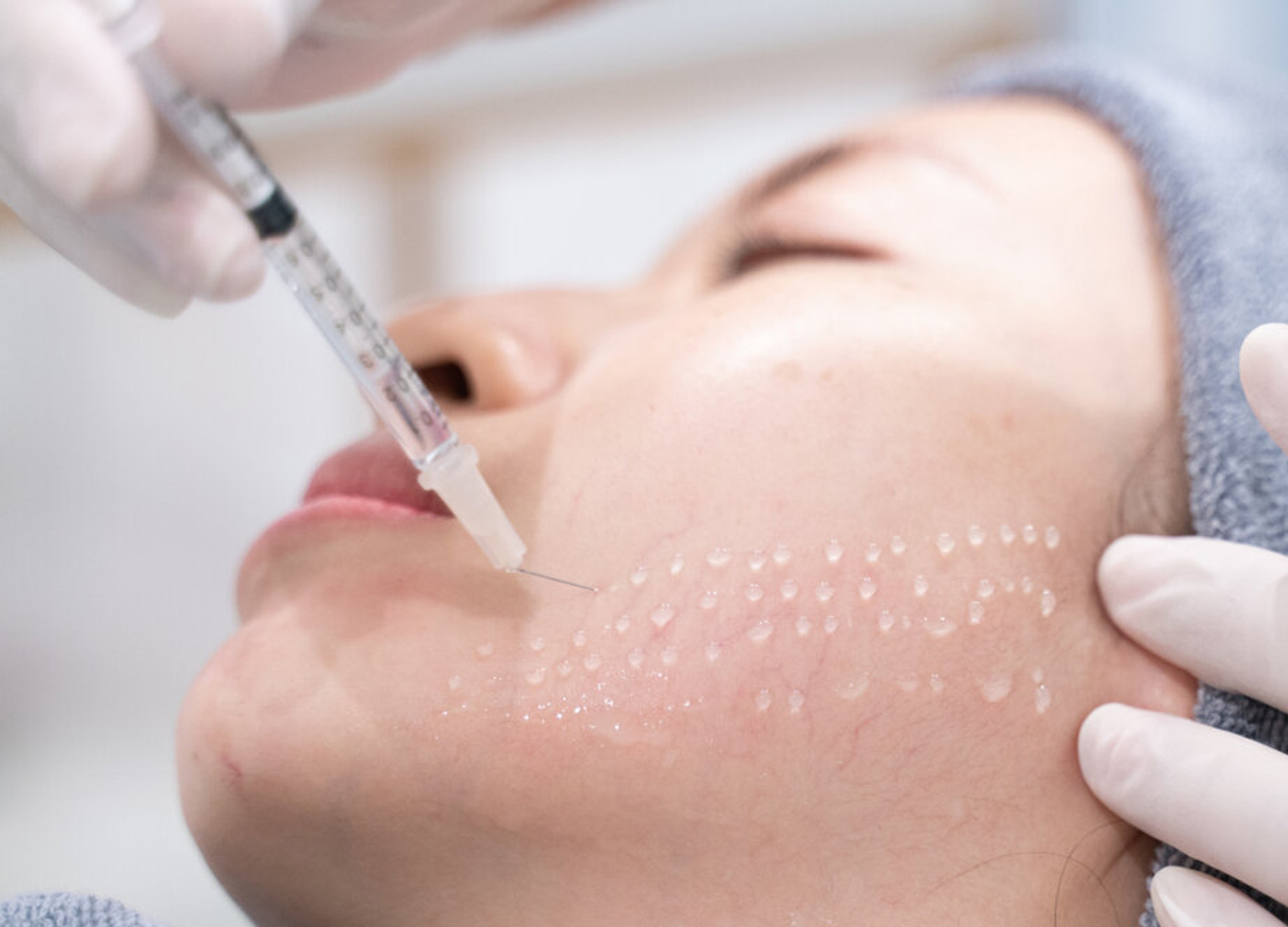 What is the Mesotherapy Nappage Technique?