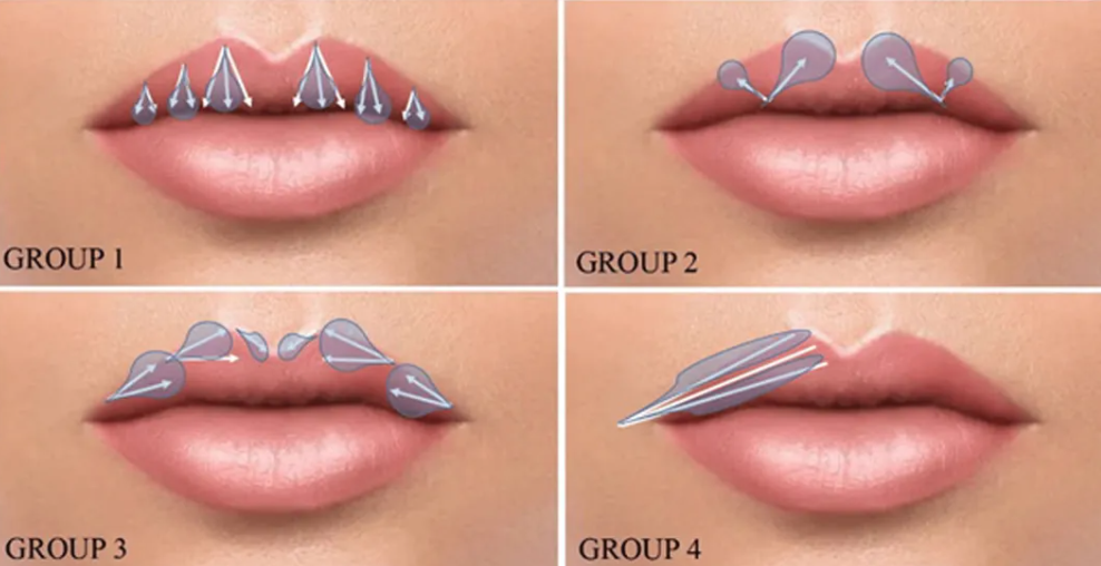 lip injection.png