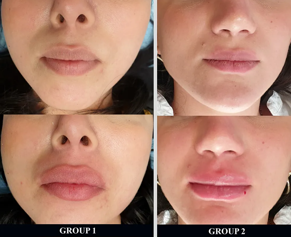 lip inject.png