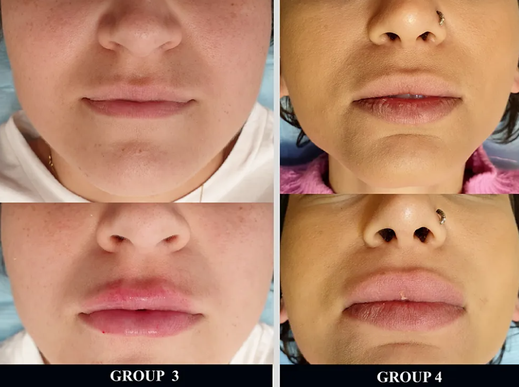 lip inject1.png