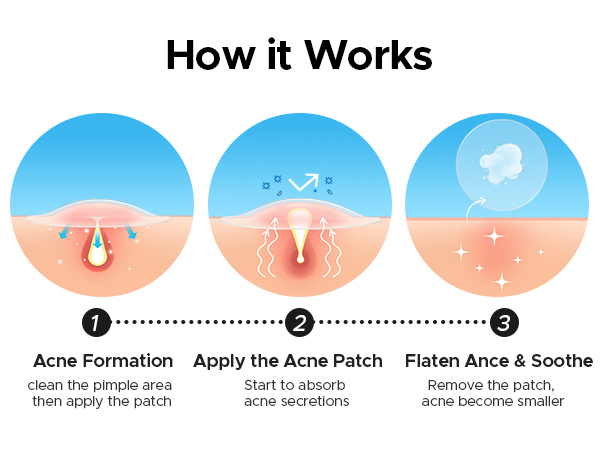 how acne patch work.jpg
