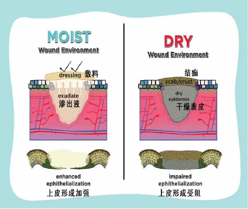 moist healing.png