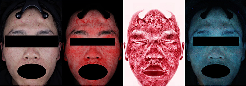 acne.jpg