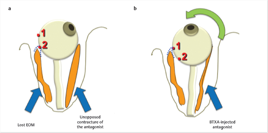 botox treatment Strabismus